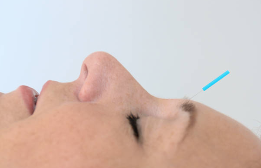 Facial Enhancement Acupuncture